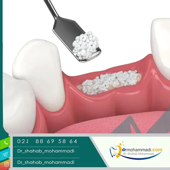 کیا پیوند استخوان فک انجام دادن